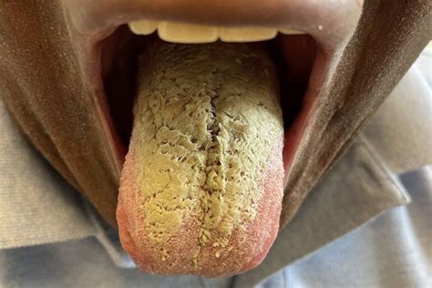 Dermatologic Clinic: Plaque on Tongue