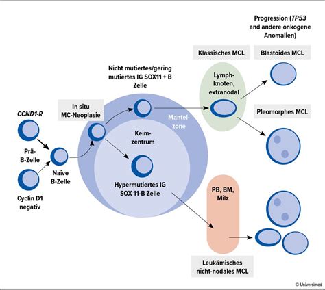 Mantelzelllymphom – die klinische Perspektive - Onkologie - Universimed ...