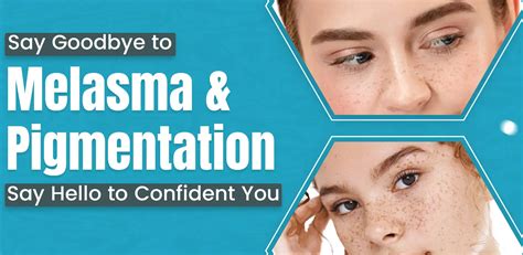Melasma Reduction in Delhi | Best Pigmentation Treatment In Delhi