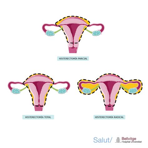 Que Es Una Histerectomia
