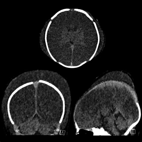 Cephalohematoma Vs Caput Succedaneum Caput Succedaneum | Pediatric