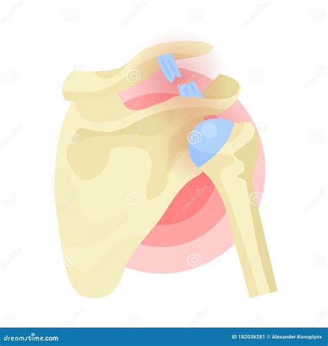 Shoulder Dislocation, Rupture of Tendon, Ligament, Joints. Musculoskeletal Trauma, Injury. Stock ...