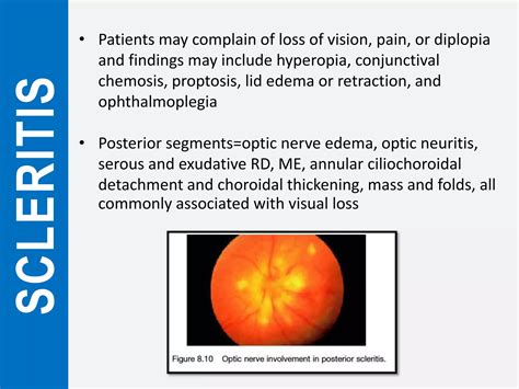 Episcleritis and scleritis | PPTX