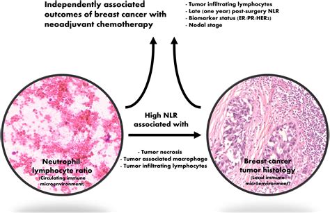 Neutrophil–lymphocyte ratio reflects tumour‐infiltrating lymphocytes and tumour‐associated ...