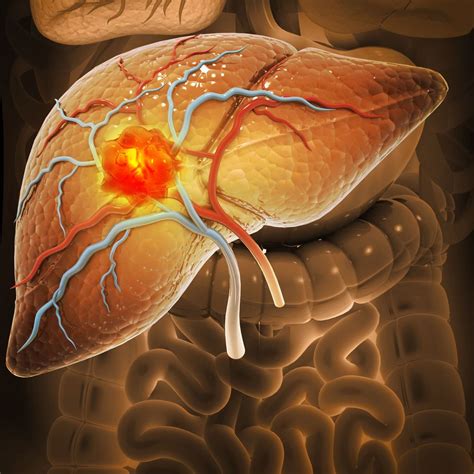Dépistage du carcinome hépatocellulaire lors d’une maladie chronique d ...