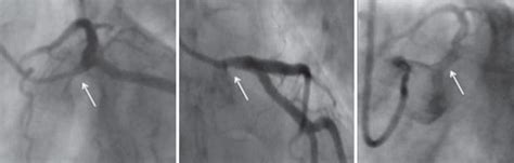 An Unusual Case of Refractory Angina