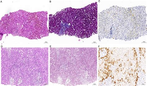 Histopathological Features Predicting Long-term Clinical Outcomes in Patients with Vanishing ...