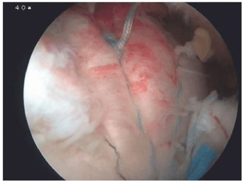 Image result for Single Row Rotator Cuff Repair