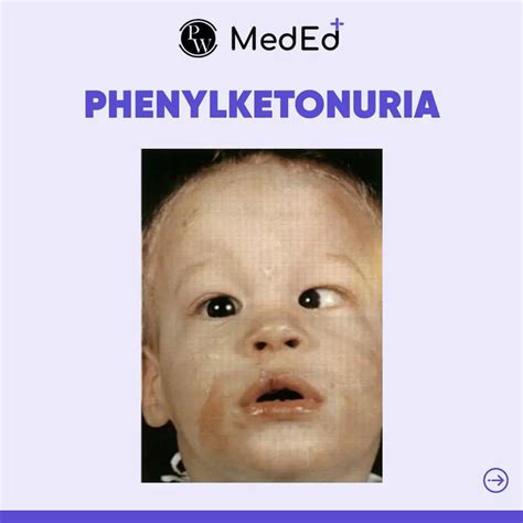 Fenilcetonuria Bebe Phenylketonuria StoryMD