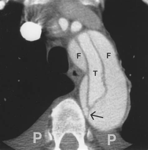 Aortic Dissection CT Features that Distinguish True Lumen from False Lumen | AJR