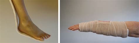 Cuidado de yesos y férula (Care of Casts and Splints) - OrthoInfo - AAOS