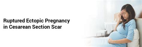 Ruptured Ectopic Pregnancy in Cesarean Section Scar