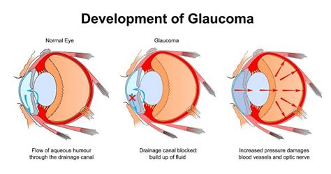 New XEN Gel Stent is the Next-Generation Treatment for Glaucoma ...