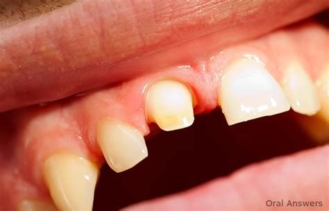 Tooth Crown Cement 的图像结果