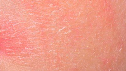Focus on psoriasis and seborrhoeic dermatitis | BIODERMA