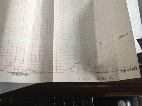 “累到早产！怀孕34周上班见了红，手术前孩子脚伸出来” - 哔哩哔哩