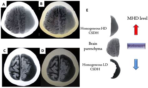 Homogeneous Chronic Subdural Hematoma with Diverse Recurrent Possibilities