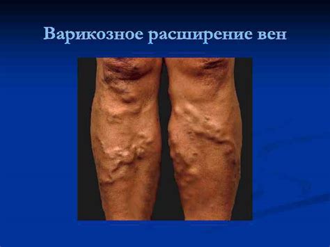Варикозное расширение вен нижних конечностей Анатомия вен