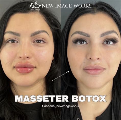 Masseter Botox Transform Your Jawline: Masseter Botox Benefits