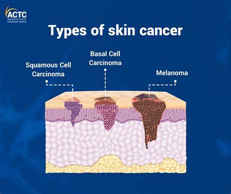 Skin Cancer Prevention: 4 Simple Ways | ACTC