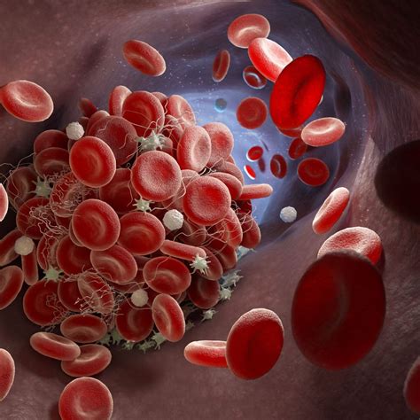 Antiplättchentherapie nach perkutaner Koronarintervention - Kardiologie ...