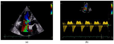 The Role of Echocardiography in the Diagnosis of Cardiac Involvement in ...