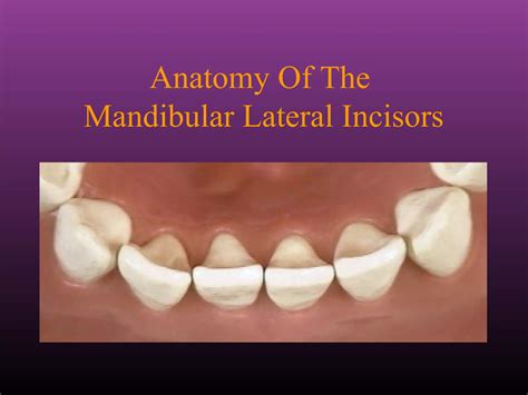 Maxillary Lateral and Mandibular Incisors | PPT