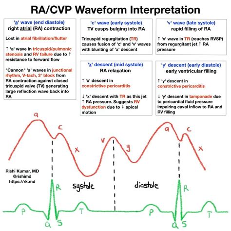 Ra cvp waveform interpretation rk md – Artofit