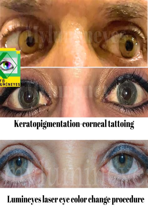 keratopigmentation and laser eye color change (Lumineyes procedure) comparison | Göz rengi, Gözler