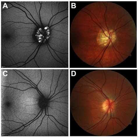 Discriminating Healthy Optic Discs and Visible Optic Disc Drusen on Fundus Autofluorescence and ...
