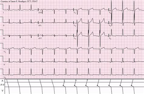 Memahami Gelombang P dalam EKG - Alomedika