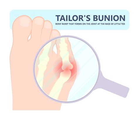 What is a Bunionette and What Should I do About it?