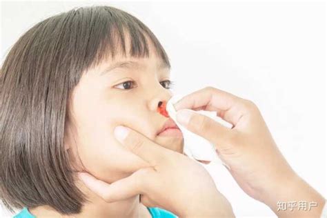 为什么小孩子容易流鼻血? - 知乎