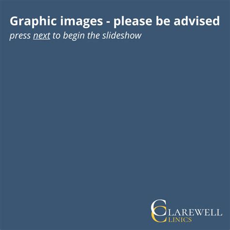 Scrotal sebaceous cysts - Clarewell Clinics