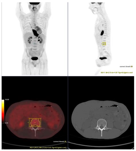 Prognostic Value of Bone Marrow Uptake Using 18F-FDG PET/CT Scans in ...