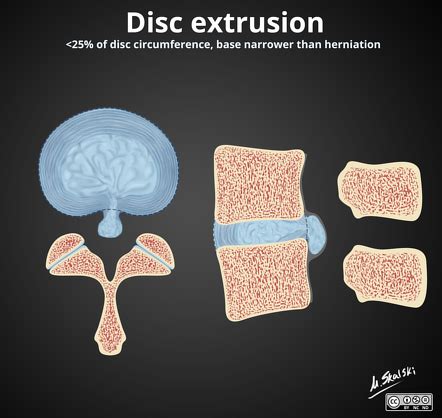 Image result for Foraminal Disc Extrusion
