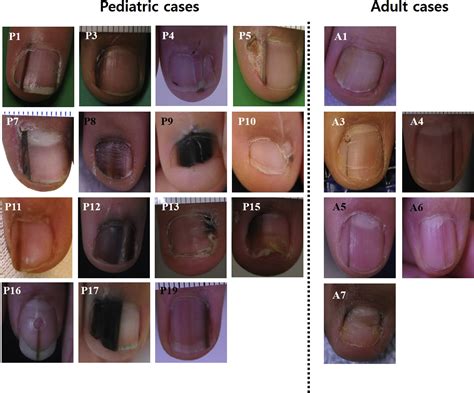 Nail Matrix Hurts at Lucinda Mccathie blog