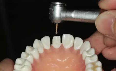 牙体预备步骤详解——硅橡胶导板制作