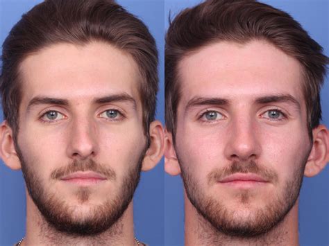 What Makes a Person’s Face Look Masculine or Feminine? (Updated 2023) – Hobgood Facial Plastic ...