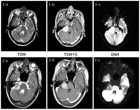 The Classification of Vestibular Schwannoma (VS) and Cerebellopontine Angle Meningioma (CPAM ...