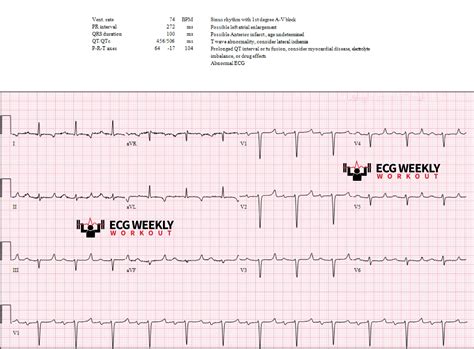 Case-445 - ECG Weekly