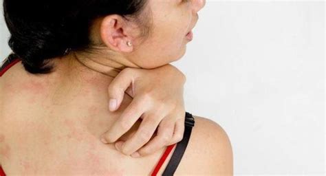 COVID-19: Kinds of rashes that may indicate infection %%page%% %%sep ...