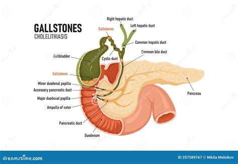 Cholelithiasis, Cholecystitis. Formations in the Gallbladder. Blockage of the Bile Duct ...