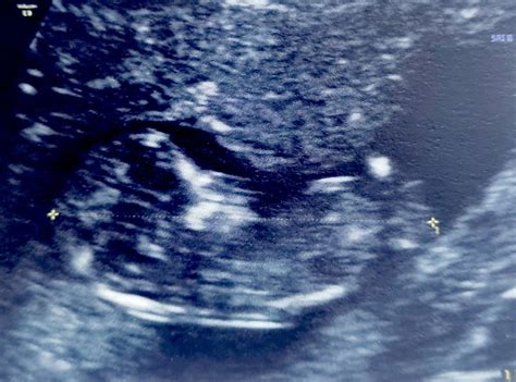 Nub or umbilical cord | BabyCenter