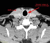 Radiotherapy | Targeting Cancer