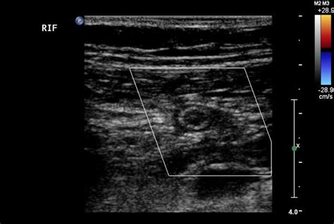 Normal Appendix Ultrasound SciELO Brasil Ultrasonographic