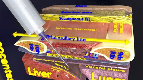 thorax thoracotomy thoracocentesis intercostal nerve block 3D model - Superhive (formerly ...