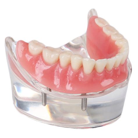 SOARDAY Dental Restoration Model with 4 implants India | Ubuy
