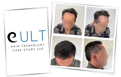 Hair Transplant Case Study 153 | Cult Aesthetics