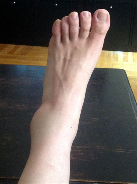 Foot And Ankle Swelling After Knee Injury at Sarah Bugarin blog